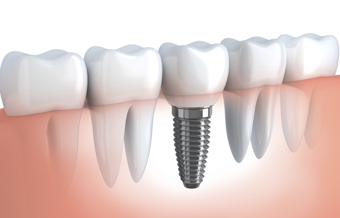 San Antonio dental implants